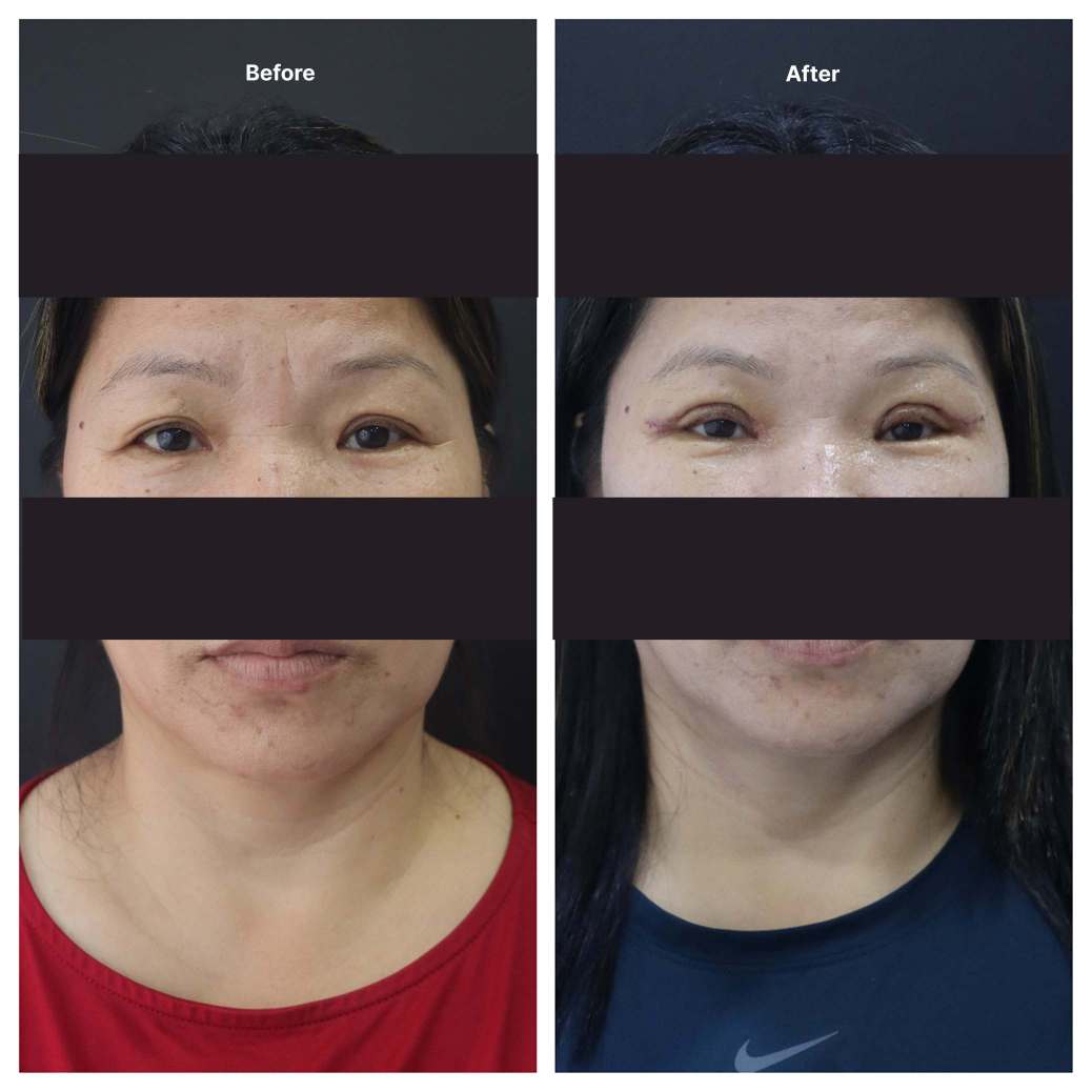 Eyelid Surgery KOQ10
